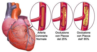 occlusione arteria