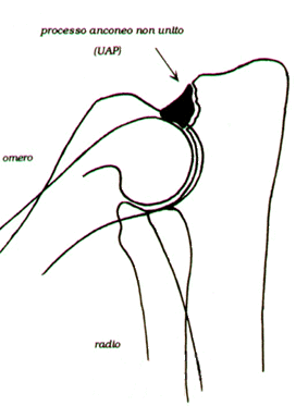 schema displasia gomito