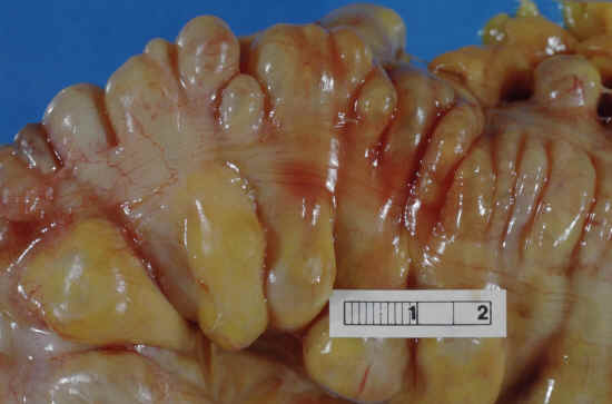 diverticolite