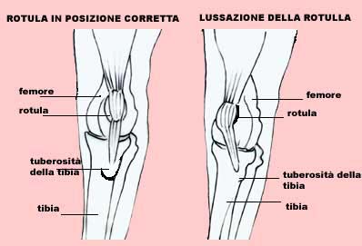 lussazione della rotula