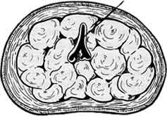 prostata ipertrofica