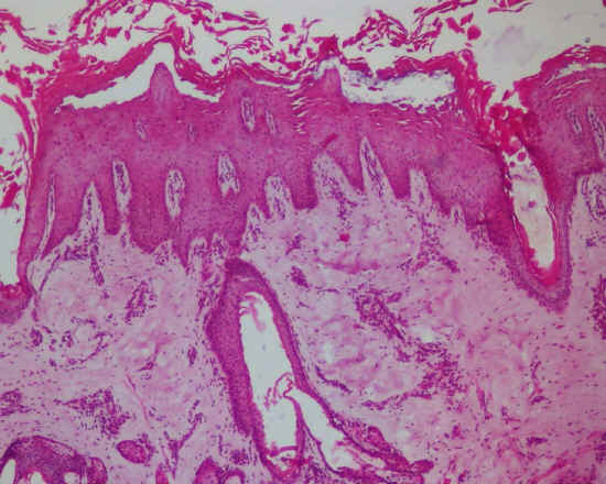 Epitelio pavimentoso stratificato cheratinizzato