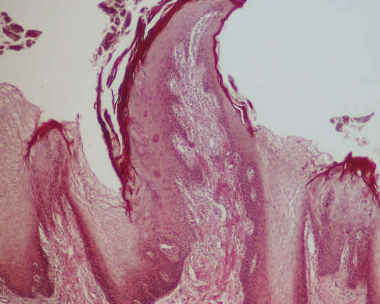 pavimentoso stratificato cheratinizzato